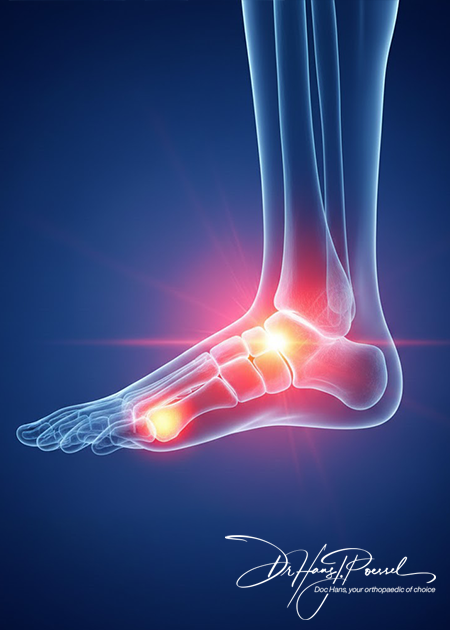 Hallux Valgus & Bunions