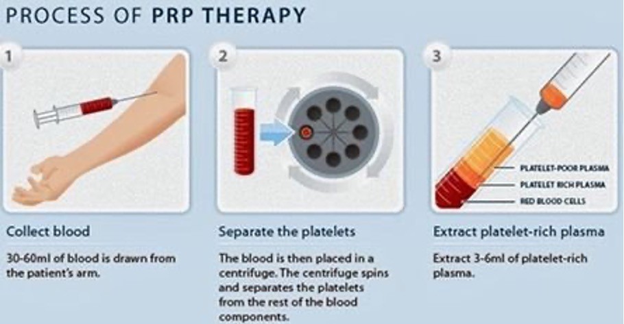 platelet rich plasma therapy fast safe does it work